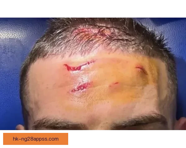 克尔斯托维奇晒伤口照回应风波